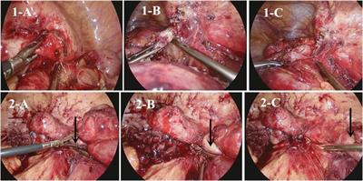 Minimally invasive surgery in Crohn’s disease: state-of-the-art review